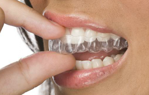 Clear Correct invisible Braces